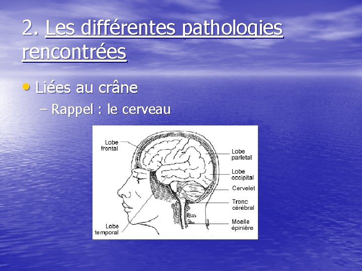 2. Les différentes pathologies rencontrées • Liées au crâne – Rappel : le cerveau