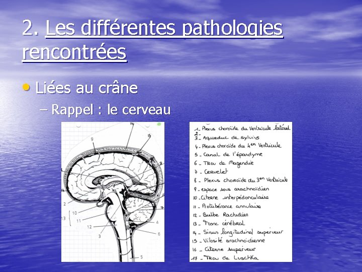 2. Les différentes pathologies rencontrées • Liées au crâne – Rappel : le cerveau