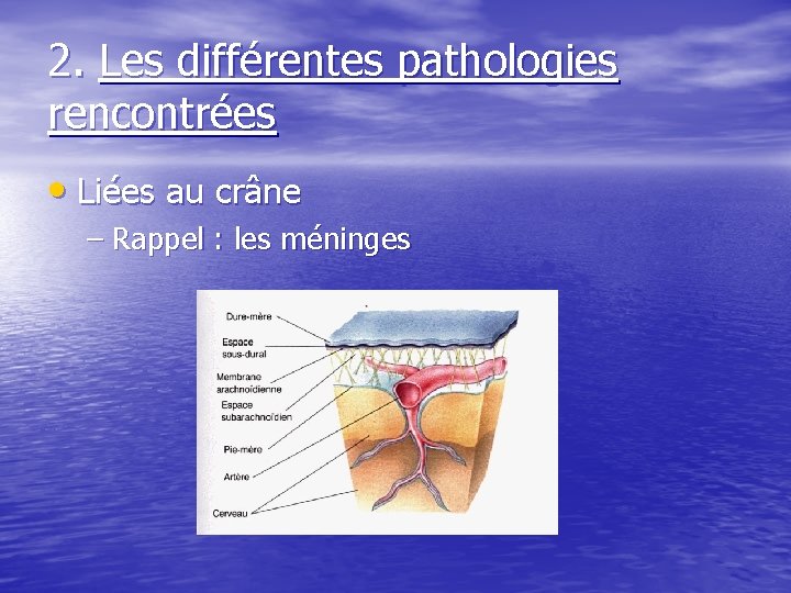 2. Les différentes pathologies rencontrées • Liées au crâne – Rappel : les méninges