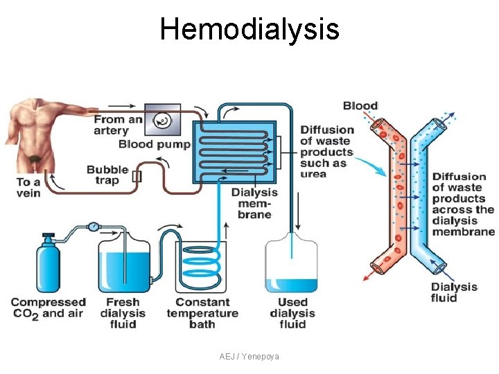 Hemodialysis AEJ / Yenepoya Hemodialysis AEJ / Yenepoya