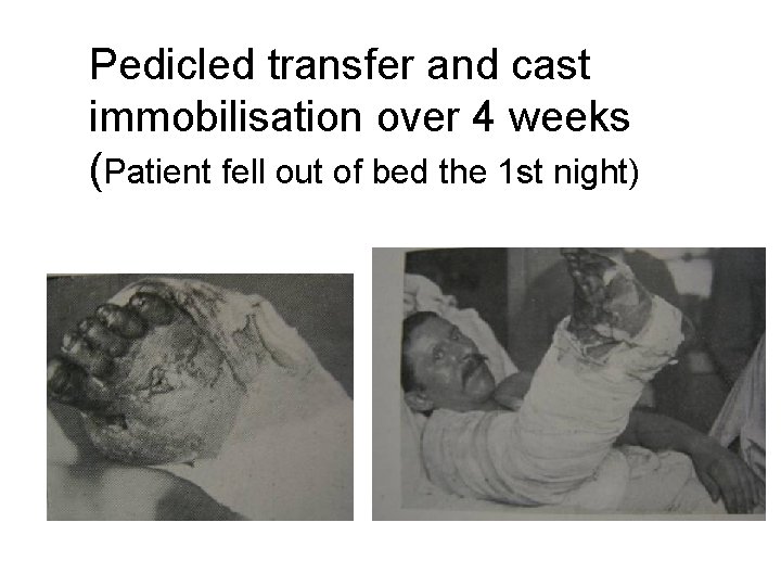 Pedicled transfer and cast immobilisation over 4 weeks (Patient fell out of bed the