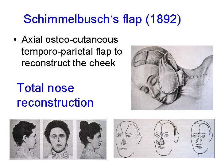 Schimmelbusch‘s flap (1892) • Axial osteo-cutaneous temporo-parietal flap to reconstruct the cheek Total nose