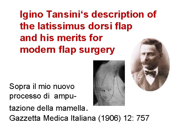 Igino Tansini‘s description of the latissimus dorsi flap and his merits for modern flap