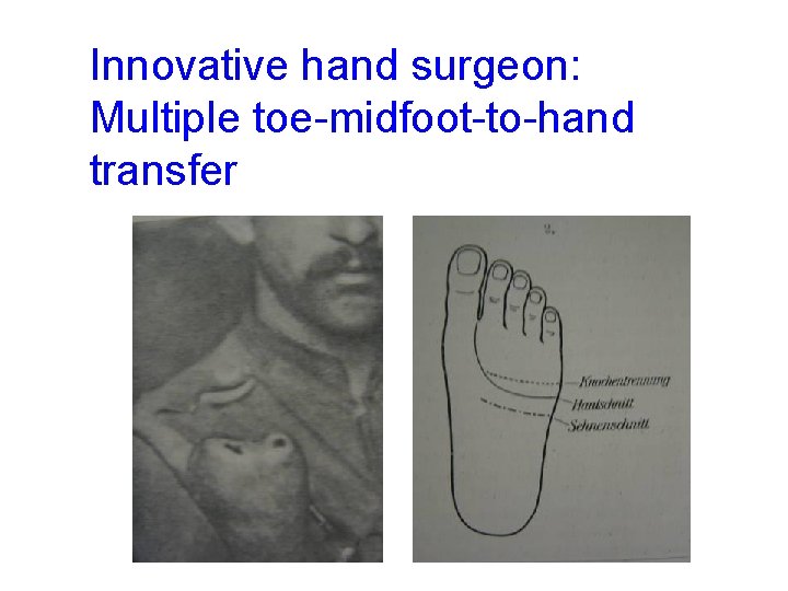 Innovative hand surgeon: Multiple toe-midfoot-to-hand transfer 
