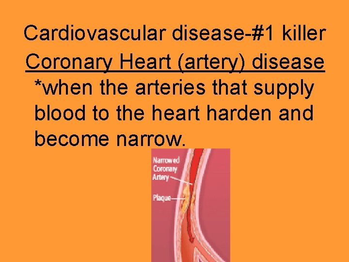 Cardiovascular disease-#1 killer Coronary Heart (artery) disease *when the arteries that supply blood to Cardiovascular disease-#1 killer Coronary Heart (artery) disease *when the arteries that supply blood to