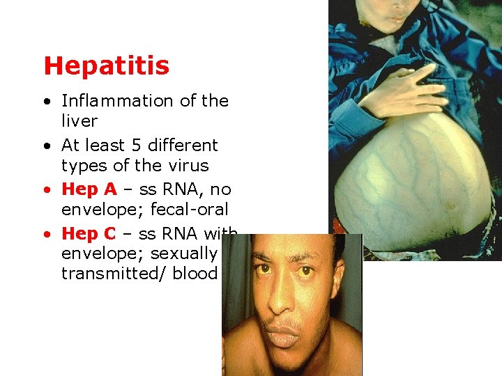 Hepatitis • Inflammation of the liver • At least 5 different types of the