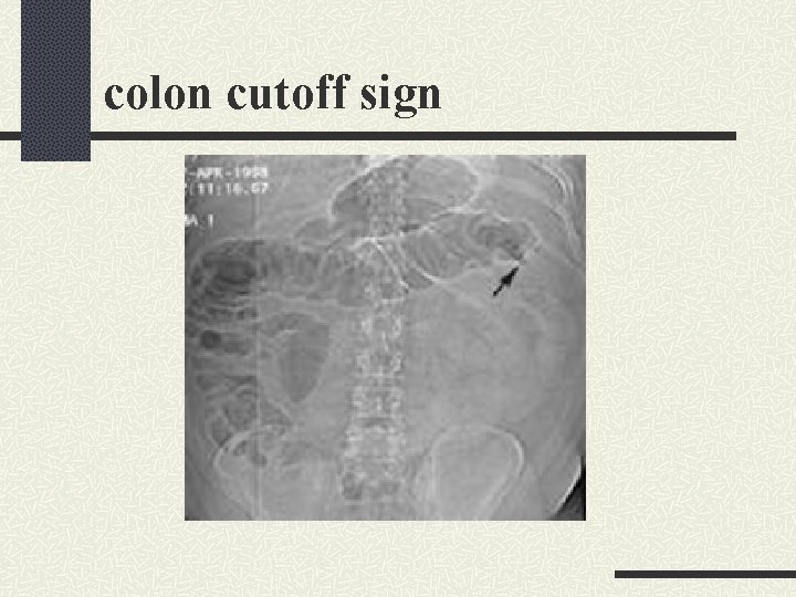 colon cutoff sign colon cutoff sign