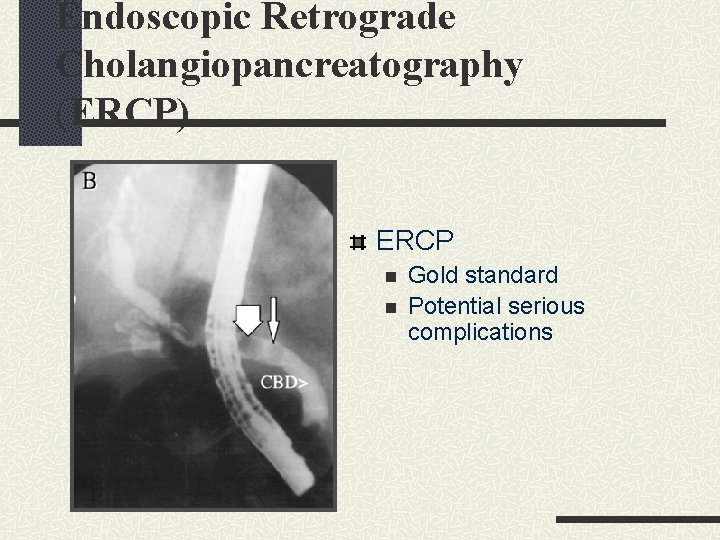 Endoscopic Retrograde Cholangiopancreatography (ERCP) ERCP n n Gold standard Potential serious complications Endoscopic Retrograde Cholangiopancreatography (ERCP) ERCP n n Gold standard Potential serious complications