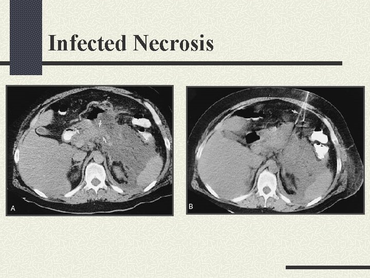 Infected Necrosis Infected Necrosis