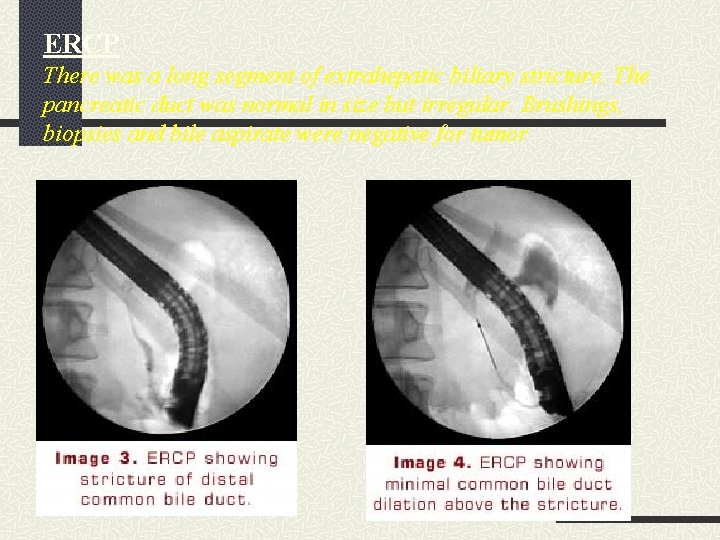 ERCP There was a long segment of extrahepatic biliary stricture. The pancreatic duct was ERCP There was a long segment of extrahepatic biliary stricture. The pancreatic duct was