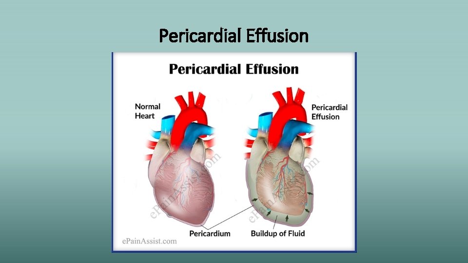 Pericardial Effusion 