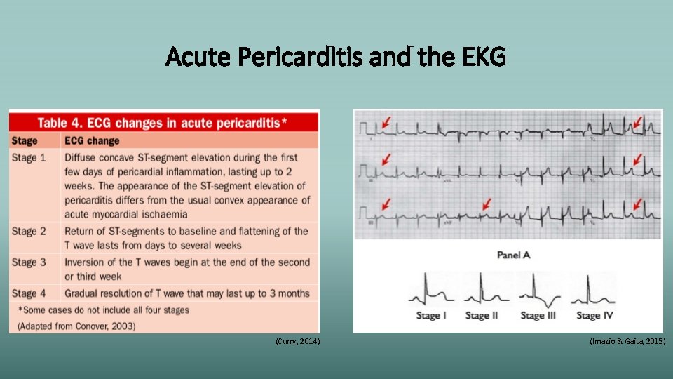 Acute Pericarditis and the EKG (Curry, 2014) (Imazio & Gaita, 2015) 