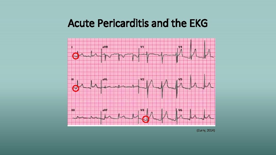 Acute Pericarditis and the EKG (Curry, 2014) 