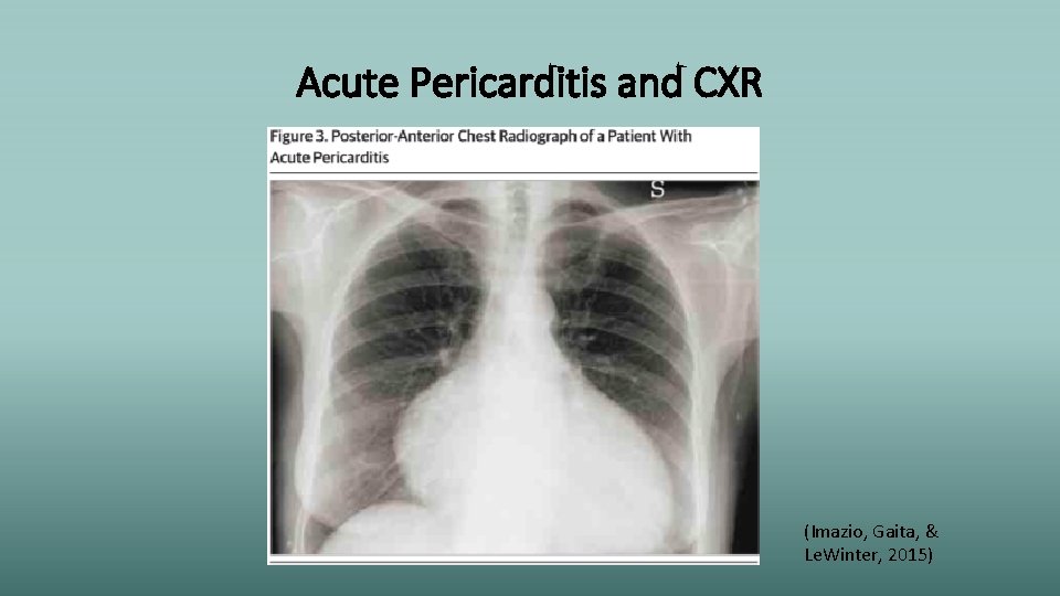 Acute Pericarditis and CXR (Imazio, Gaita, & Le. Winter, 2015) 