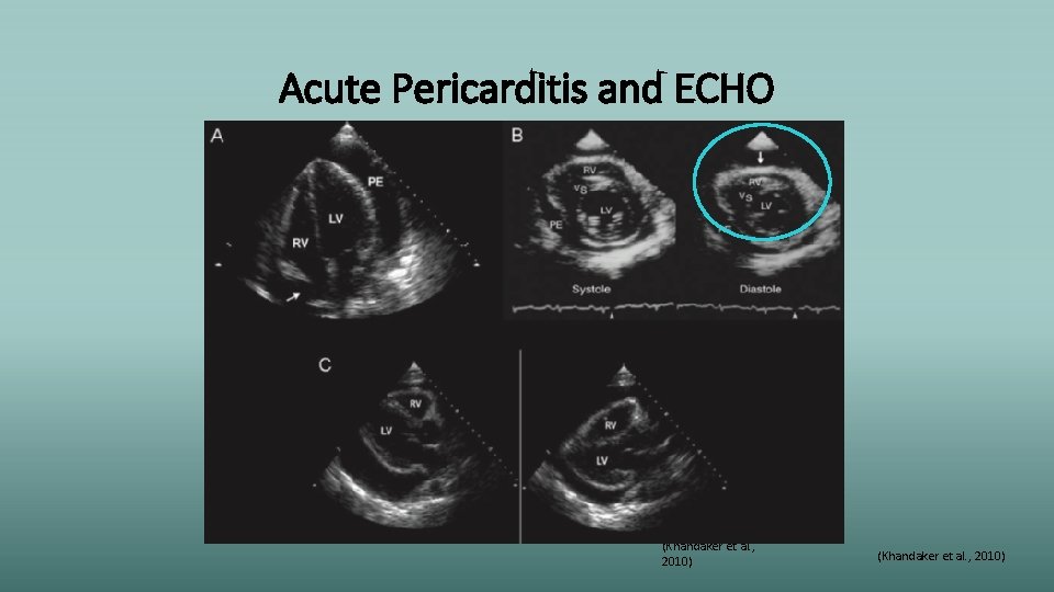 Acute Pericarditis and ECHO (Khandaker et al. , 2010) 