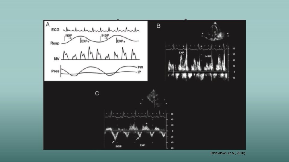 Cardiac Tamponade Durand et al. (2009) (Khandaker et al. , 2010) 
