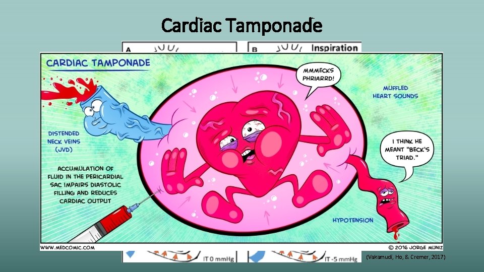 Cardiac Tamponade (Vakamudi, Ho, & Cremer, 2017) 