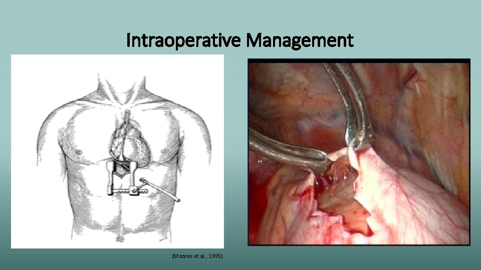 Intraoperative Management (Moores et al. , 1995) 