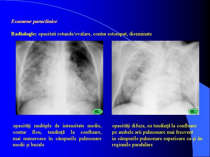 Examene paraclinice Radiologic: opacitati rotunde/ovalare, contur estompat, diseminate opacităţi multiple de intensitate medie, contur