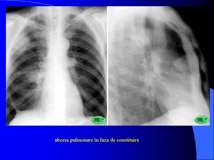 abcese pulmonare în faza de constituire 