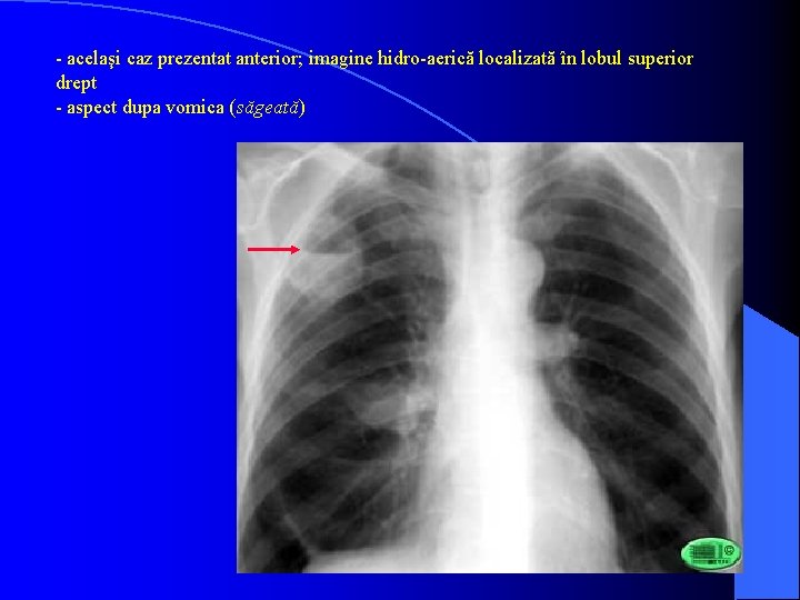 - acelaşi caz prezentat anterior; imagine hidro-aerică localizată în lobul superior drept - aspect