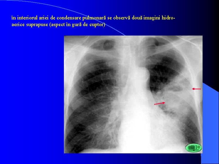 în interiorul ariei de condensare pulmonară se observă două imagini hidroaerice suprapuse (aspect în