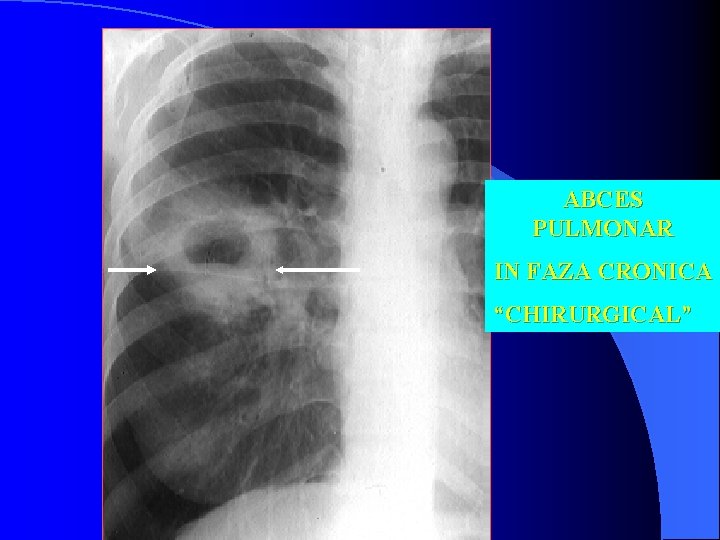 ABCES PULMONAR IN FAZA CRONICA “CHIRURGICAL” 