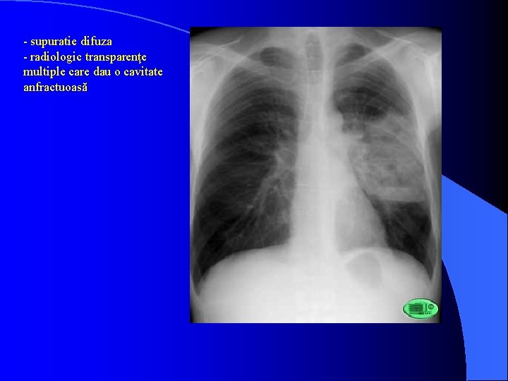 - supuratie difuza - radiologic transparenţe multiple care dau o cavitate anfractuoasă 