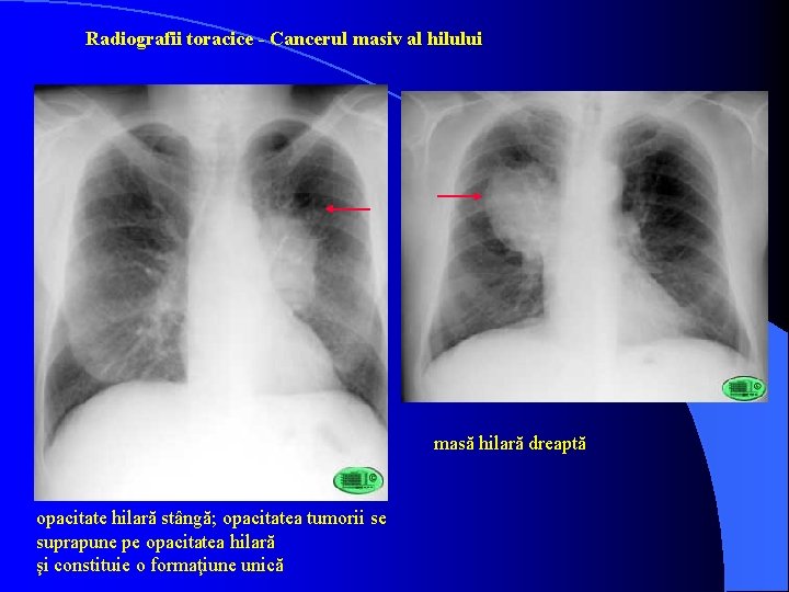 Radiografii toracice - Cancerul masiv al hilului masă hilară dreaptă opacitate hilară stângă; opacitatea