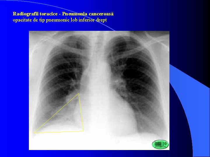 Radiografii toracice - Pneumonia canceroasă opacitate de tip pneumonic lob inferior drept 