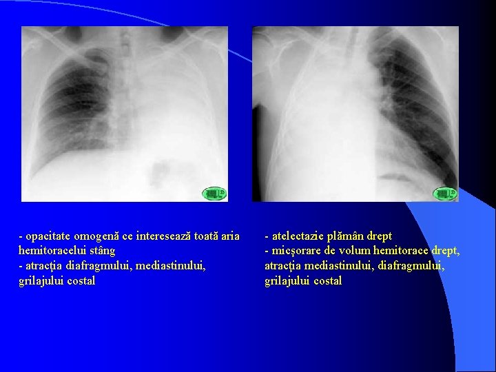 - opacitate omogenă ce interesează toată aria hemitoracelui stâng - atracţia diafragmului, mediastinului, grilajului