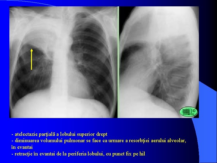 - atelectazie parţială a lobului superior drept - diminuarea volumului pulmonar se face ca