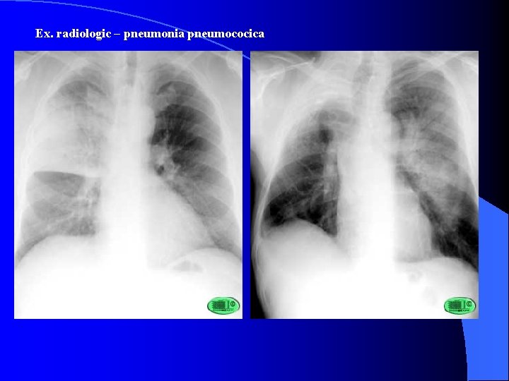 Ex. radiologic – pneumonia pneumococica 