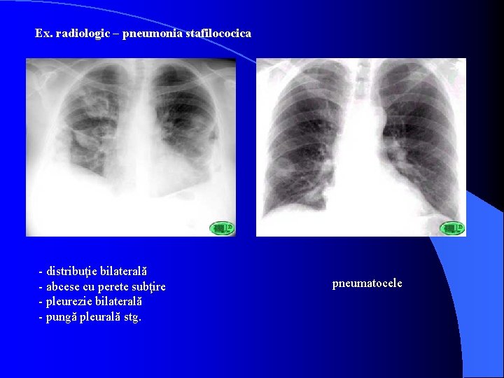 Ex. radiologic – pneumonia stafilococica - distribuţie bilaterală - abcese cu perete subţire -