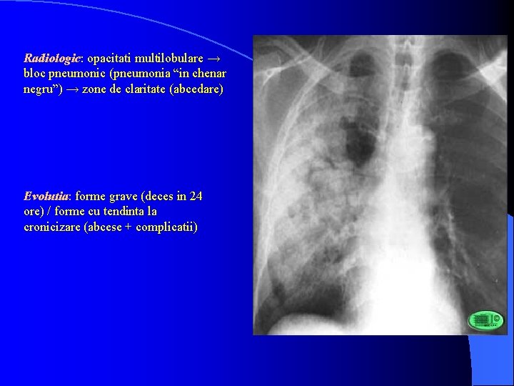 Radiologic: opacitati multilobulare → bloc pneumonic (pneumonia “in chenar negru”) → zone de claritate