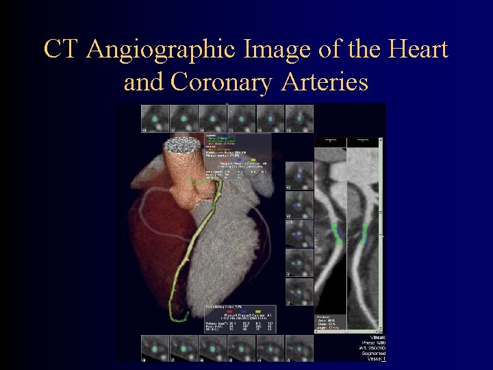 CT Angiographic Image of the Heart and Coronary Arteries 