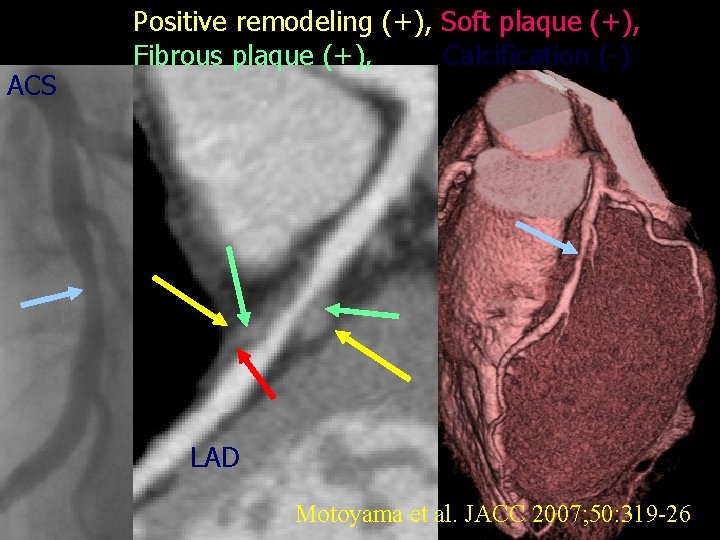 ACS Positive remodeling (+), Soft plaque (+), Fibrous plaque (+), Calcification (-) LAD Motoyama
