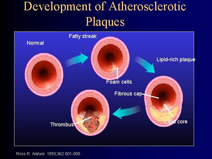 Development of Atherosclerotic Plaques Fatty streak Normal Lipid-rich plaque Foam cells Fibrous cap Thrombus