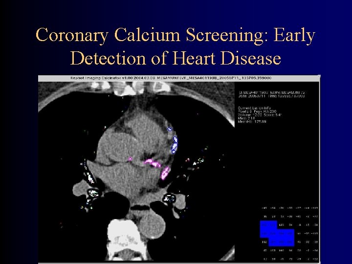 Coronary Calcium Screening: Early Detection of Heart Disease 