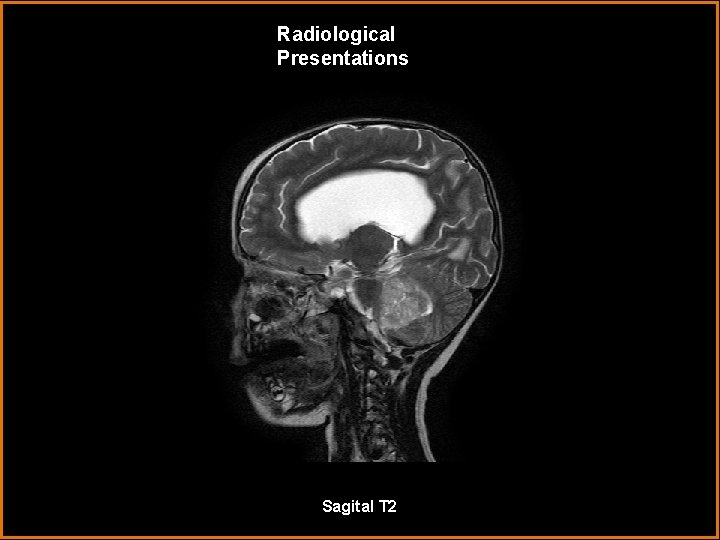 Radiological Presentations Sagital T 2 