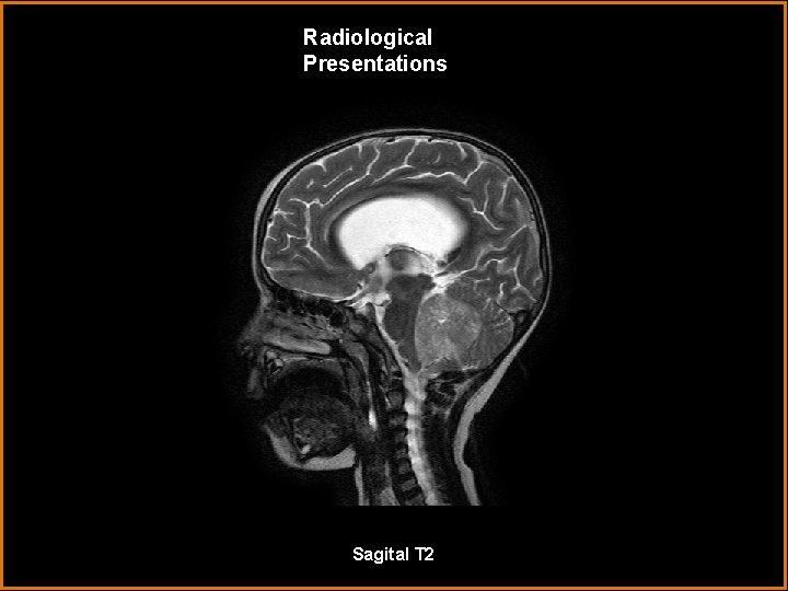 Radiological Presentations Sagital T 2 