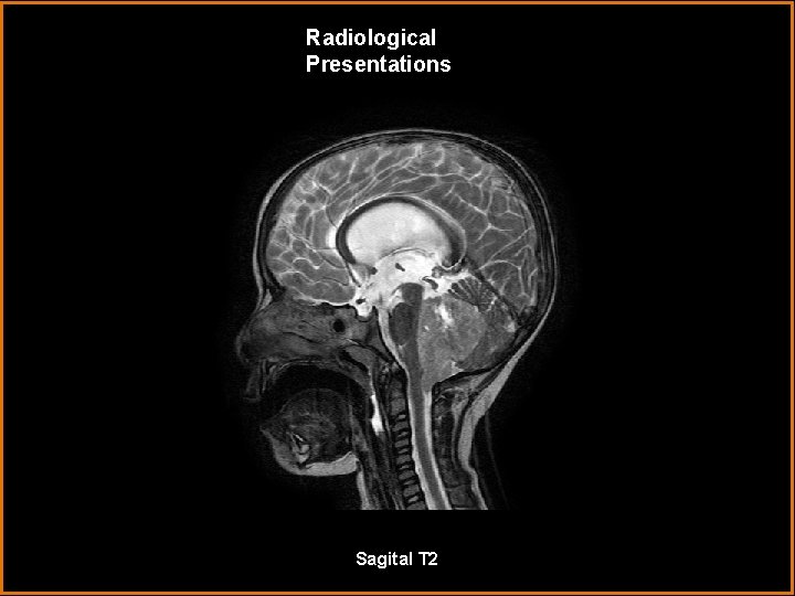 Radiological Presentations Sagital T 2 