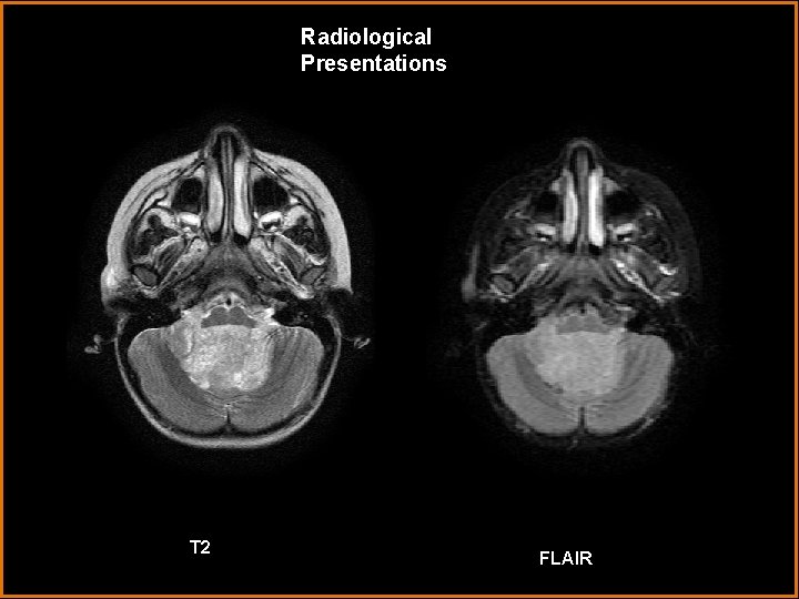 Radiological Presentations T 2 FLAIR 