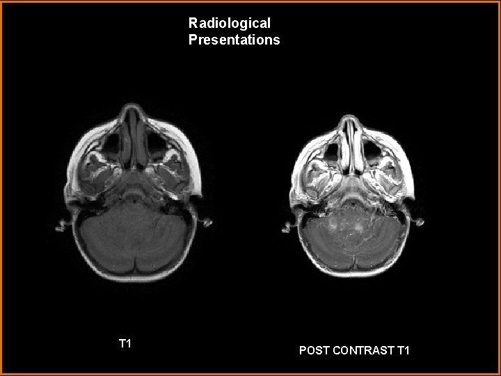 Radiological Presentations T 1 POST CONTRAST T 1 