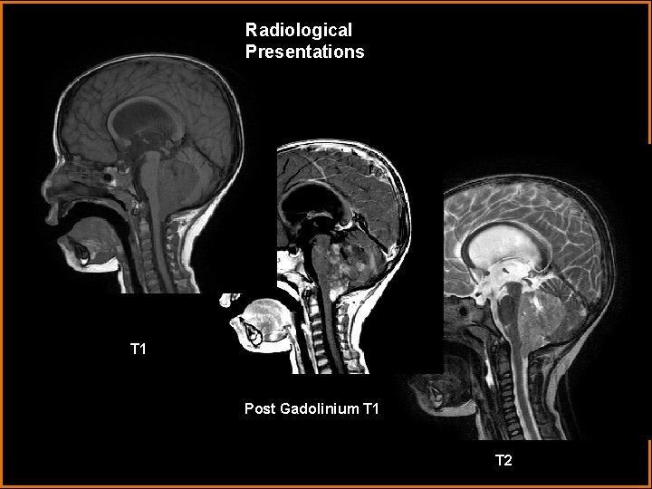 Radiological Presentations T 1 Post Gadolinium T 1 T 2 