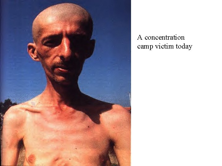 A concentration camp victim today 