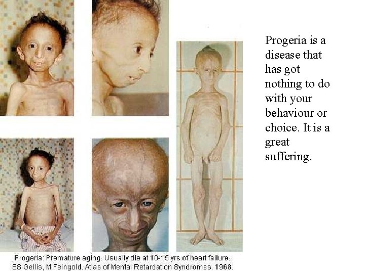 Progeria is a disease that has got nothing to do with your behaviour or