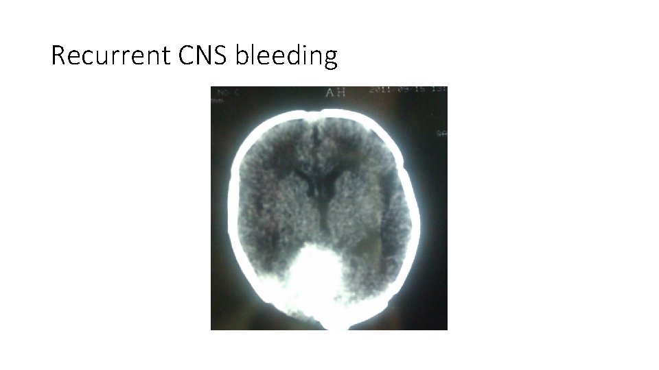 Recurrent CNS bleeding Recurrent CNS bleeding