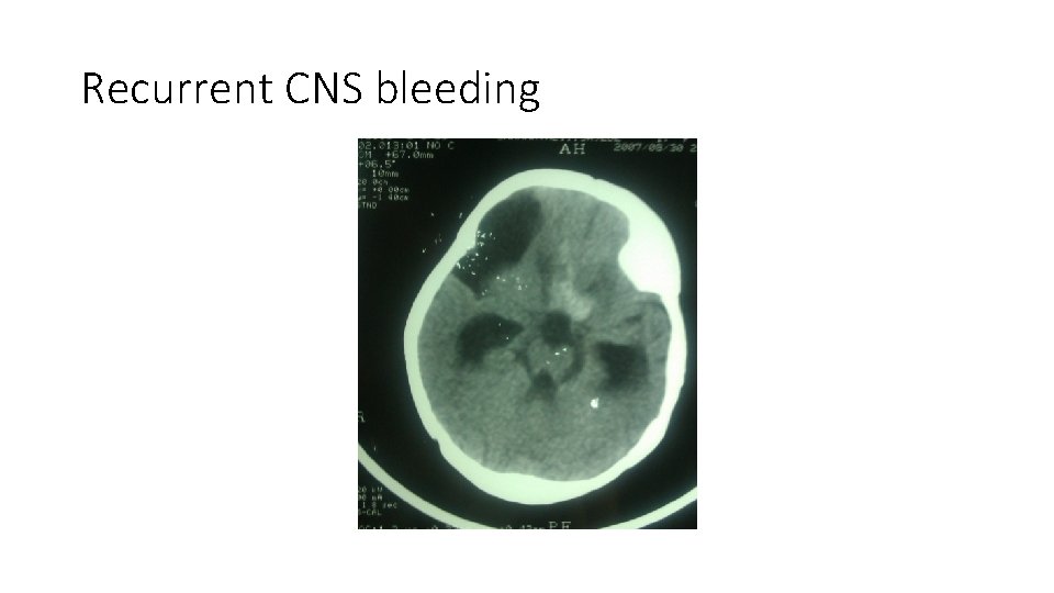 Recurrent CNS bleeding Recurrent CNS bleeding