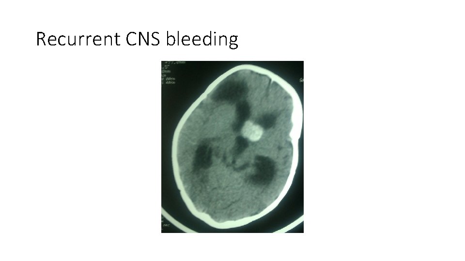 Recurrent CNS bleeding Recurrent CNS bleeding